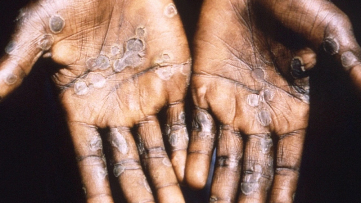 US boosts monkeypox testing, 142 cases confirmed