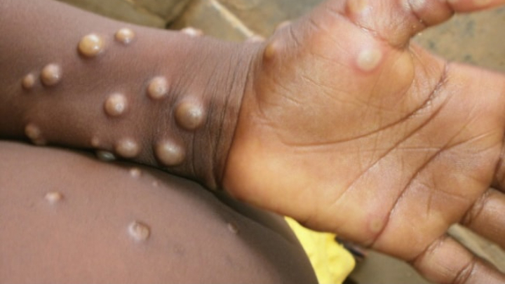 Monkeypox fatality confirmed in Los Angeles, a possible US first