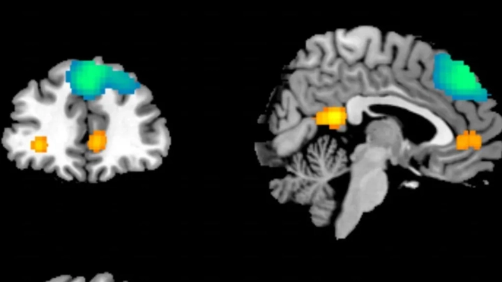 Artificial intelligence was used to highlight the areas of the brain that have been physically altered by childhood trauma